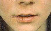 eksem - sprickor i mun