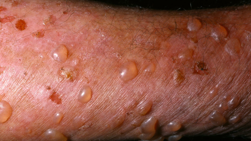 Ⓒ Anders Hallén, hudläkare Foto: Shutterstock