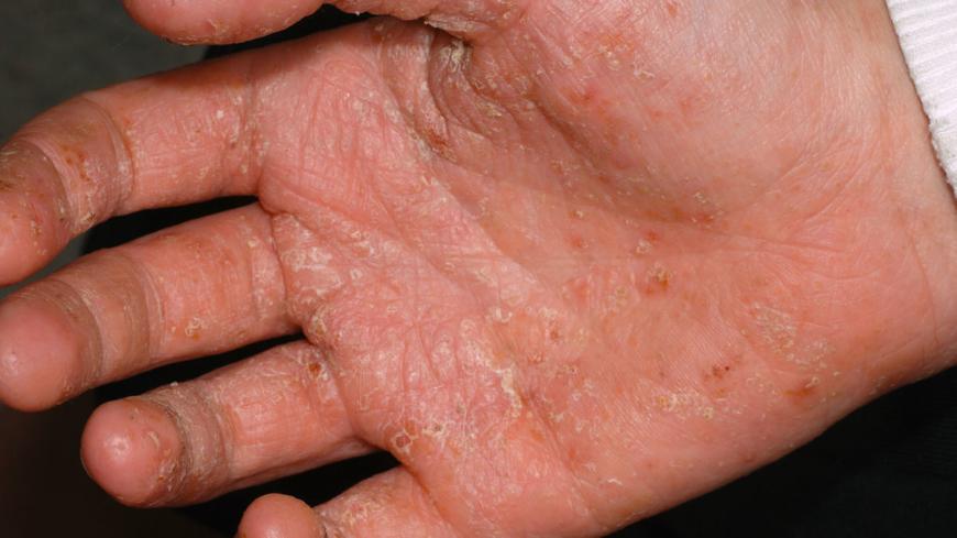 Handeksem –orsak, symtom och behandling