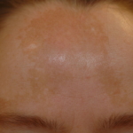 Melasma (bruna fläckar i ansiktet)