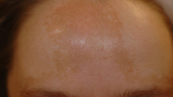 Melasma (bruna fläckar i ansiktet)