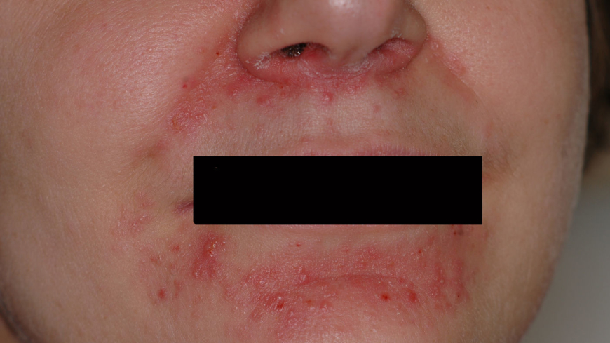 Ⓒ Anders Hallén, hudläkare Foto: Shutterstock