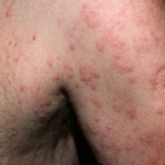 Nässelutslag (urtikaria): orsaker och förebyggande åtgärder