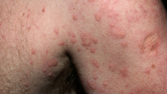 Nässelutslag (urtikaria): orsaker och förebyggande åtgärder