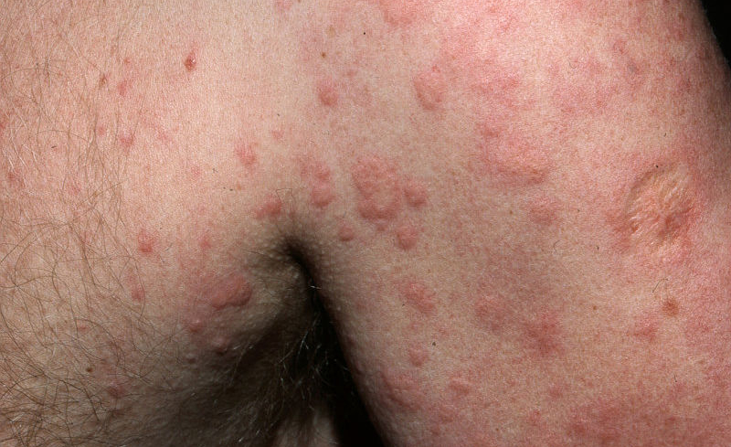 Nässelutslag (urtikaria): orsaker och förebyggande åtgärder