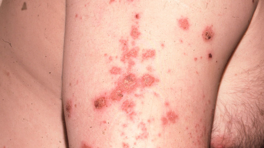 Foto: Anders Hallén, hudläkare 