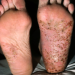 Pustulosis palmo-plantaris