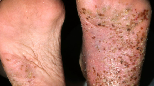 Pustulosis palmo-plantaris