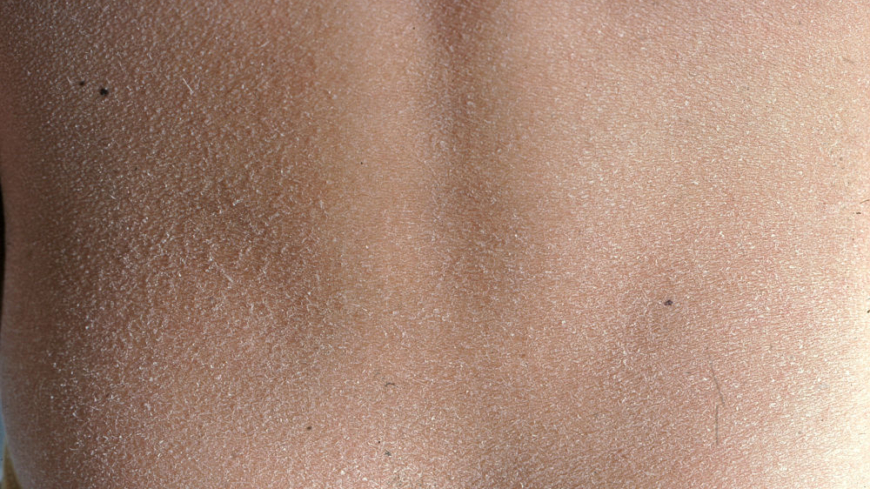  Ⓒ Anders Hallén, hudläkare Foto: Shutterstock