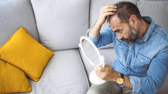 Manlig typ av håravfall