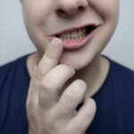 Ansiktsförlamning: symtom, orsak & behandling