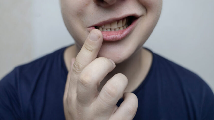 Ett snett leende kan vara ett tidigt tecken på ansiktsförlamning. Foto: Shutterstock