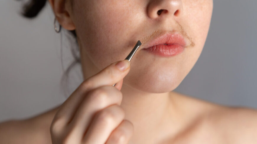 Vid hirsutism kan håret på olika platser bli grövre, mörkare och mer synligt.  Foto: Shutterstock