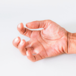 Spasticitet efter stroke: orsak, symtom & behandling   