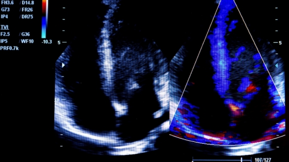 Enkammarhjärta: symtom, behandling & prognos