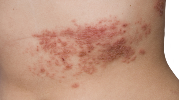 Bältros – en av fyra svenskar drabbas