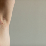 Hidradenitis suppurativa