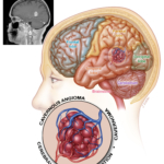 Kavernom – en sällsynt kärlmissbildning