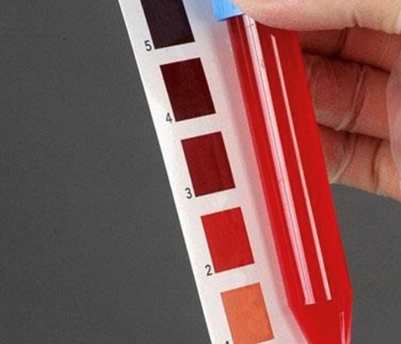 Urinblåsecancer – den ”bortglömda” cancersjukdomen