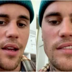 Ramsay Hunts Syndrom: ovanlig form av bältros