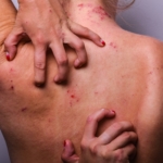 Atopiskt eksem – den glömda folksjukdomen