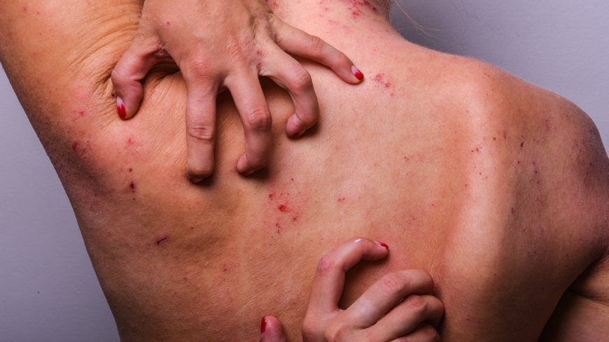 Atopiskt eksem – den glömda folksjukdomen