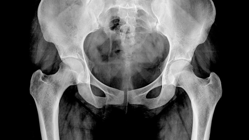 Vården missar benskörhet som beror på läkemedelsbiverkningar