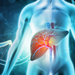 PBC -Primär biliär kolangit