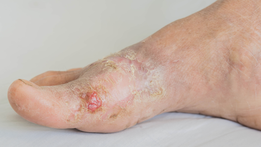 Snabbare sårläkning med svag elstöt