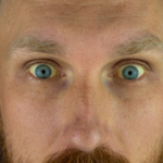 Gilberts syndrom – en genetisk leversjukdom