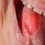 Glossit – symtom, orsak och behandling