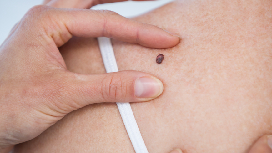 Upptäck hudcancer – boka tid hos specialist utan remiss mellan 4-8 September