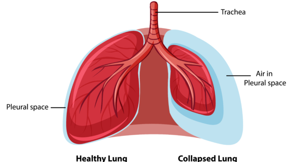 Atelektas (lungkollaps): orsak, symtom & behandling