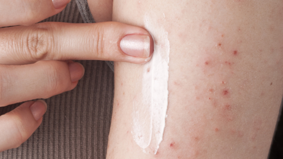 Knottrig hud (keratosis pilaris): symtom, orsak & behandling