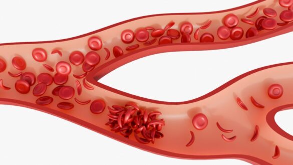 Sicklecellanemi (SCD): symtom, orsaker & behandling