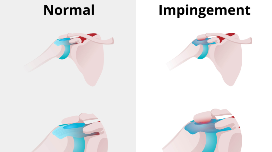 Inklämning av vävnader i axeln kan vara smärtsamt och bero på ex. överansträngning. Foto: Getty Images