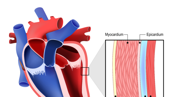 Hjärtsäcksinflammation (perikardit): orsak, symtom & behandling