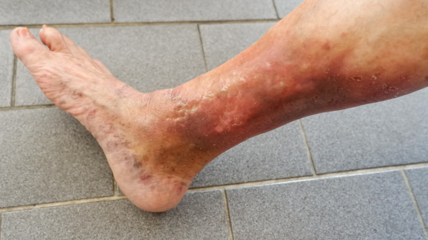 Hypostatiskt eksem beror på nedsatt venöst blodflöde i benen. Foto: Getty Images