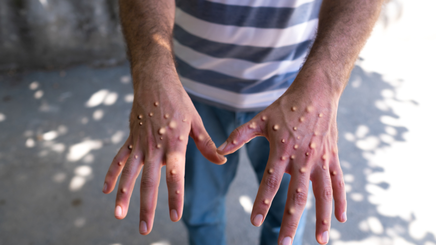 Apkoppor (mpox): riktlinjer och vaccination