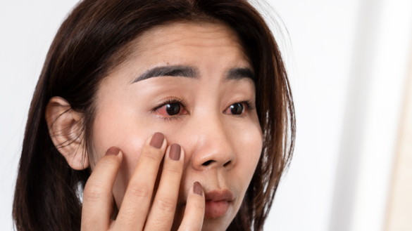 Irit (regnbågshinneinflammation): orsak, symtom & behandling