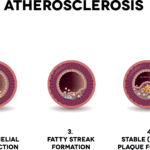 Män utvecklar ateroskleros 10 år tidigare än kvinnor