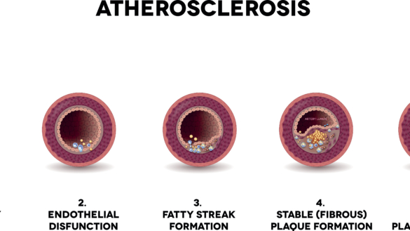 Män utvecklar ateroskleros 10 år tidigare än kvinnor