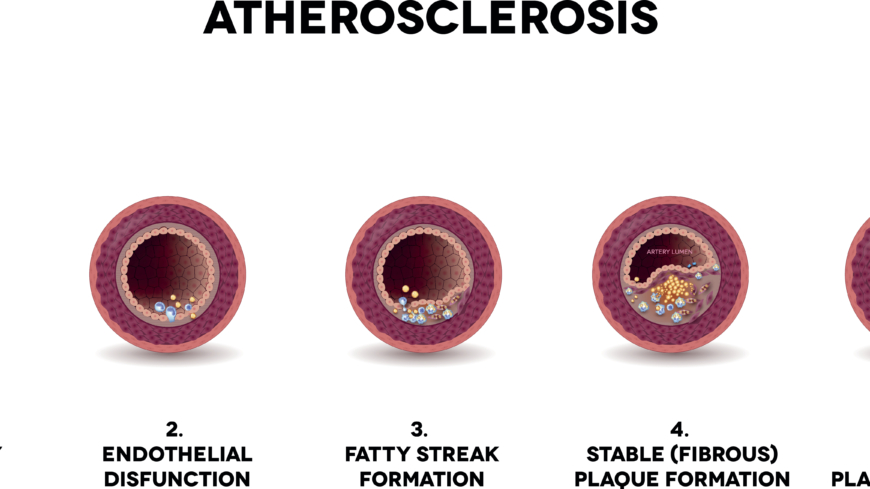 Män utvecklar ateroskleros 10 år tidigare än kvinnor