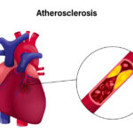 Åderförfettning (ateroskleros): orsak, symtom & behandling