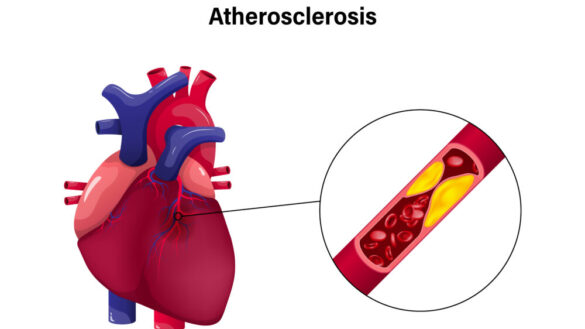 Åderförfettning (ateroskleros): orsak, symtom & behandling