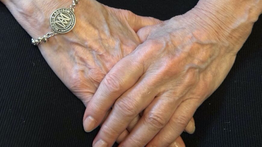 Addisons sjukdom: att åldras med sjukdomen