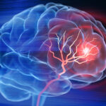 TIA – orsak, symtom & behandling