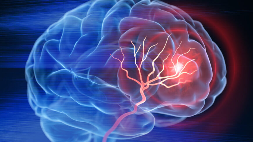 En transitorisk ischemisk attack, TIA, är en tillfällig störning i blodflödet till hjärnan. Det är en varningssignal om att en stroke kan vara nära förestående.  Foto: Getty Images