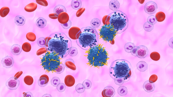 Kronisk lymfatisk leukemi (KLL) – symtom, orsak och behandling