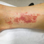 Granulomatös polyangit (GPA) – orsak, symtom & behandling